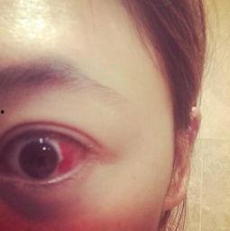 眼睛出血的图片,视觉健康警示与应对策略